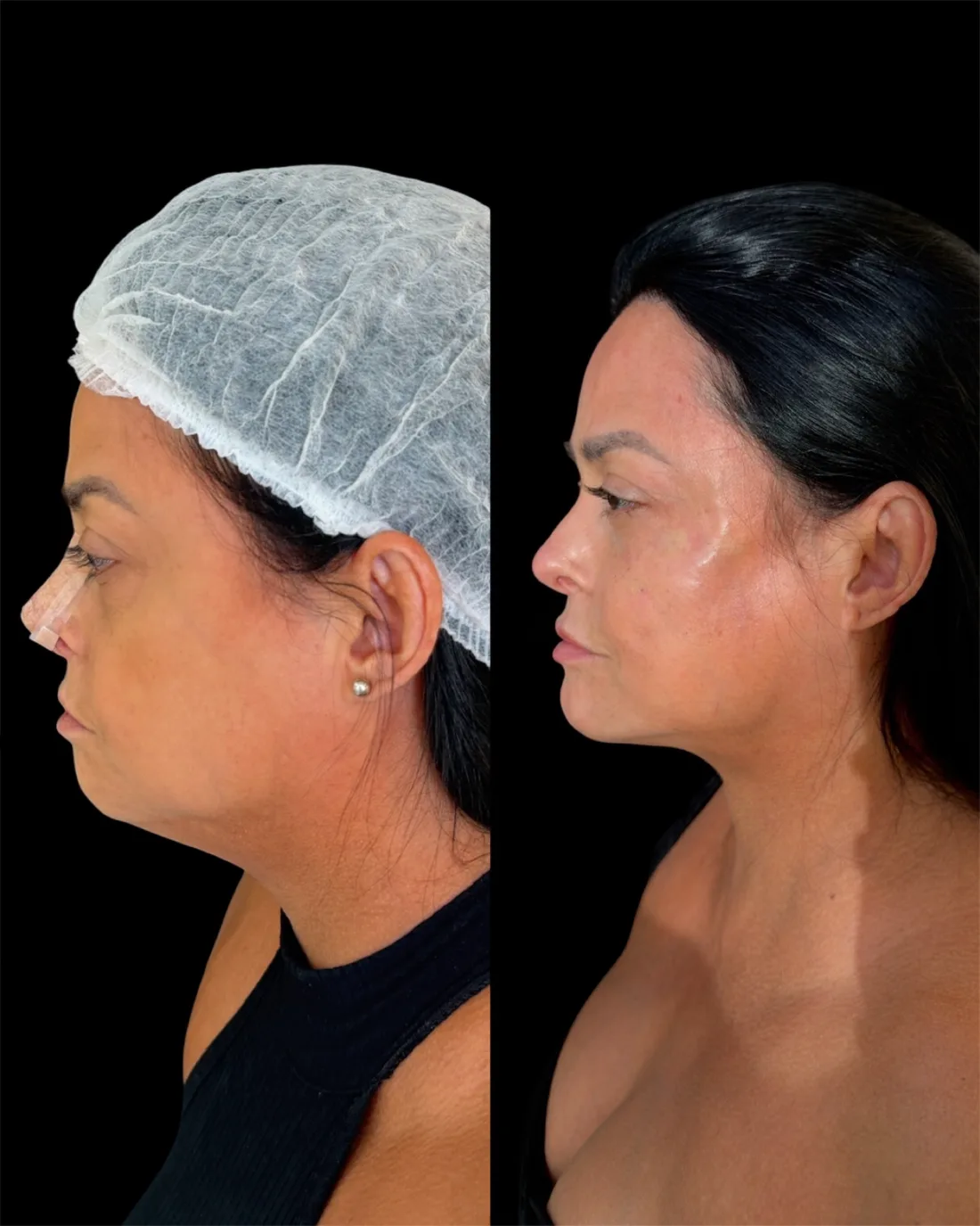 Caso 1 de harmonização facial: registro clínico, antes e depois