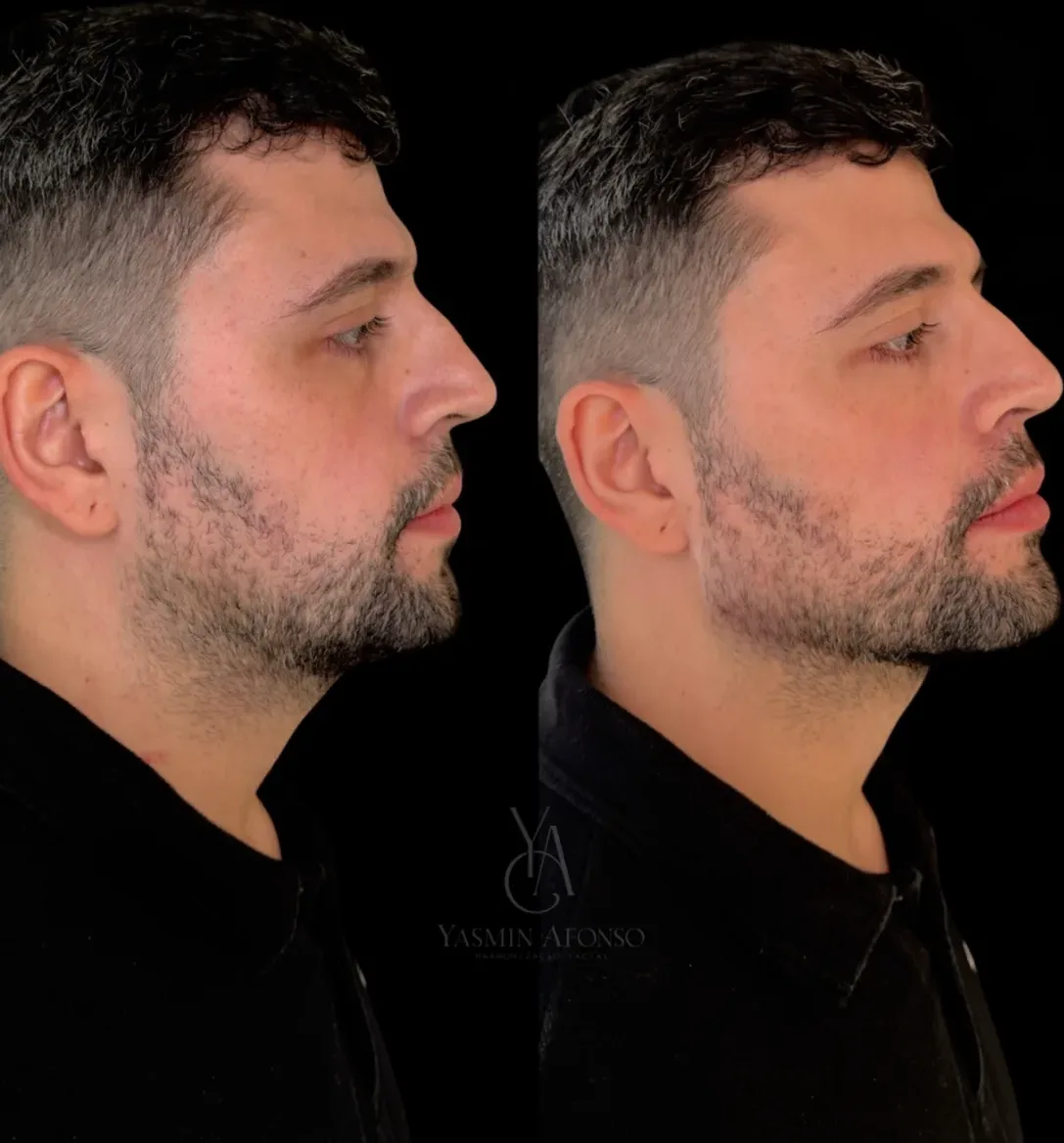 Caso 2 de harmonização facial: registro clínico, antes e depois