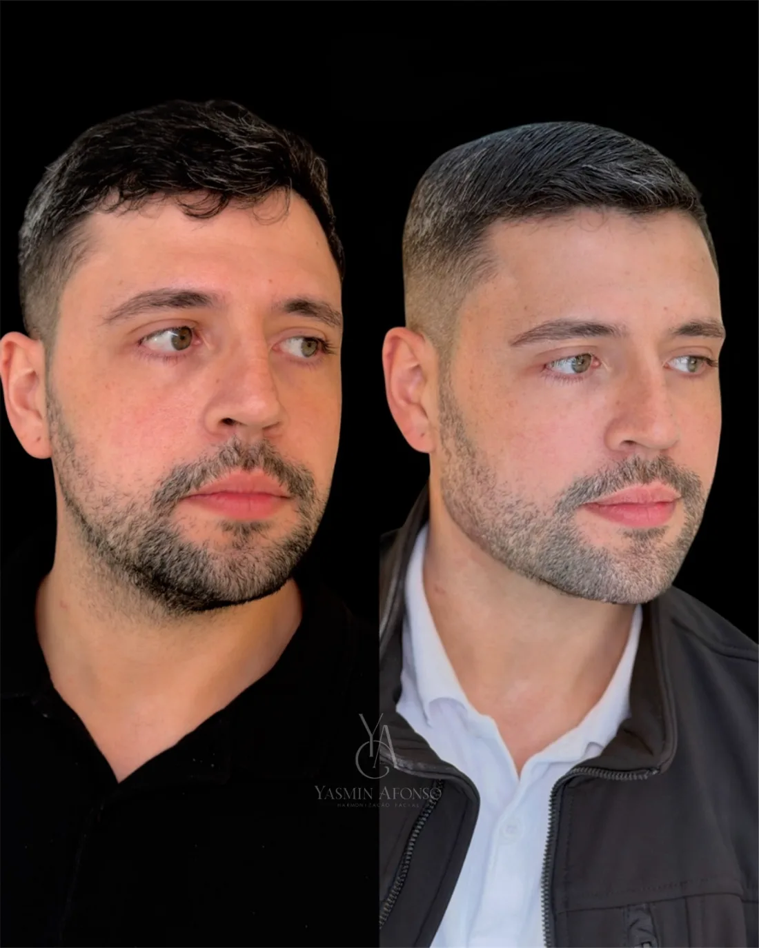 Caso 3 de harmonização facial: registro clínico, antes e depois