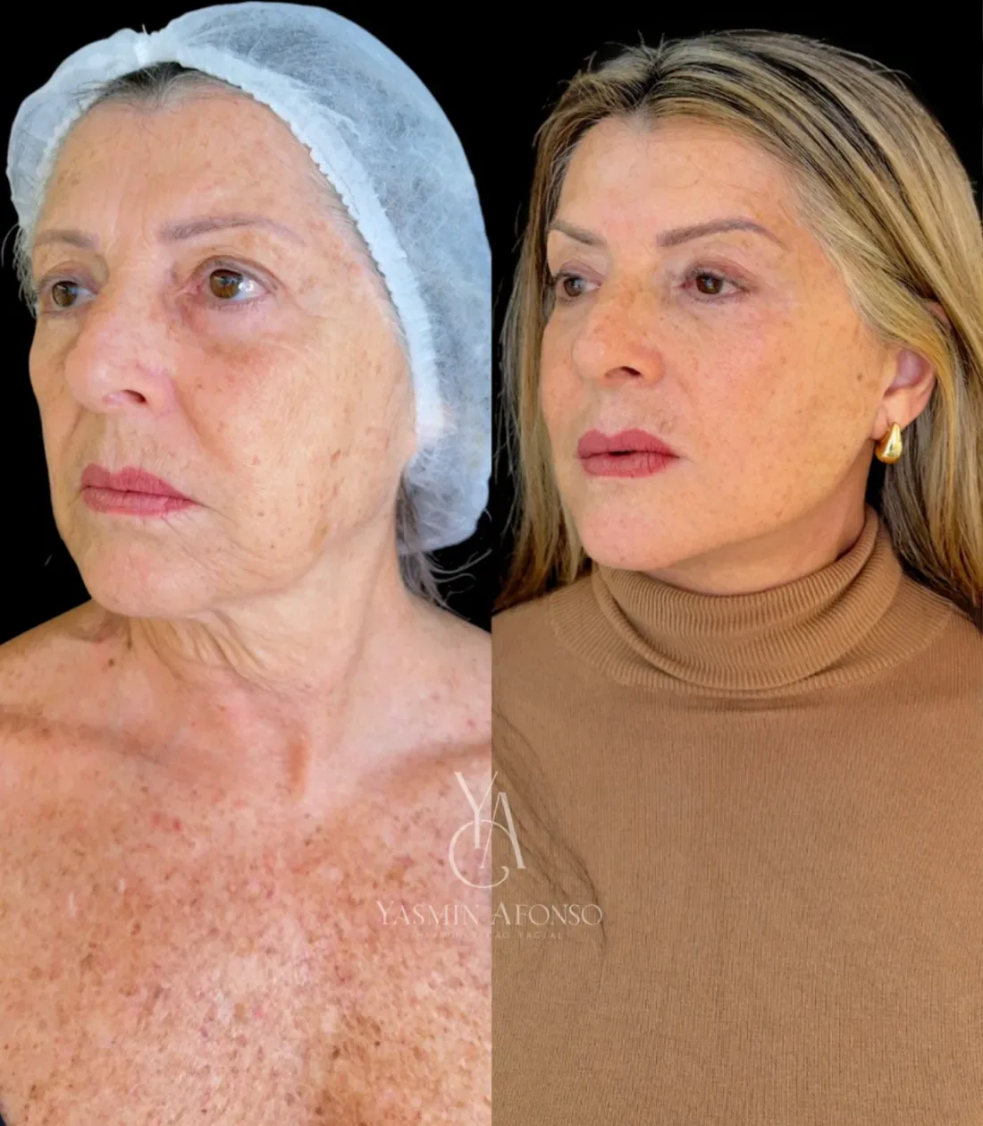 Caso 4 de harmonização facial: registro clínico, antes e depois