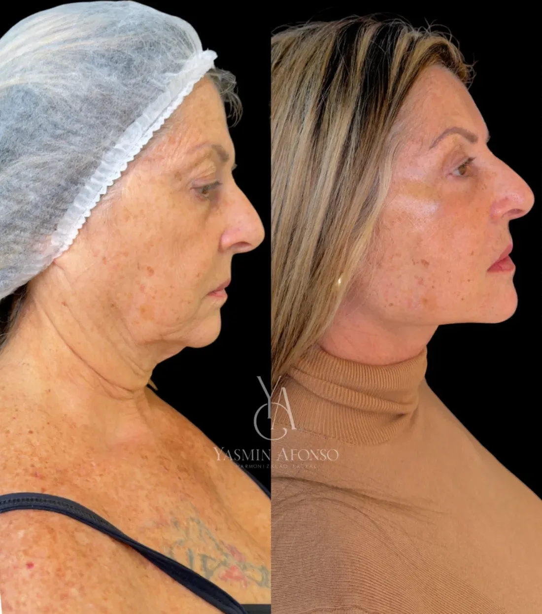 Caso 5 de harmonização facial: registro clínico, antes e depois