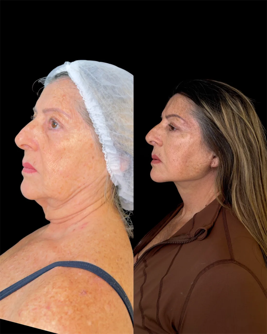 Caso 6 de harmonização facial: registro clínico, antes e depois