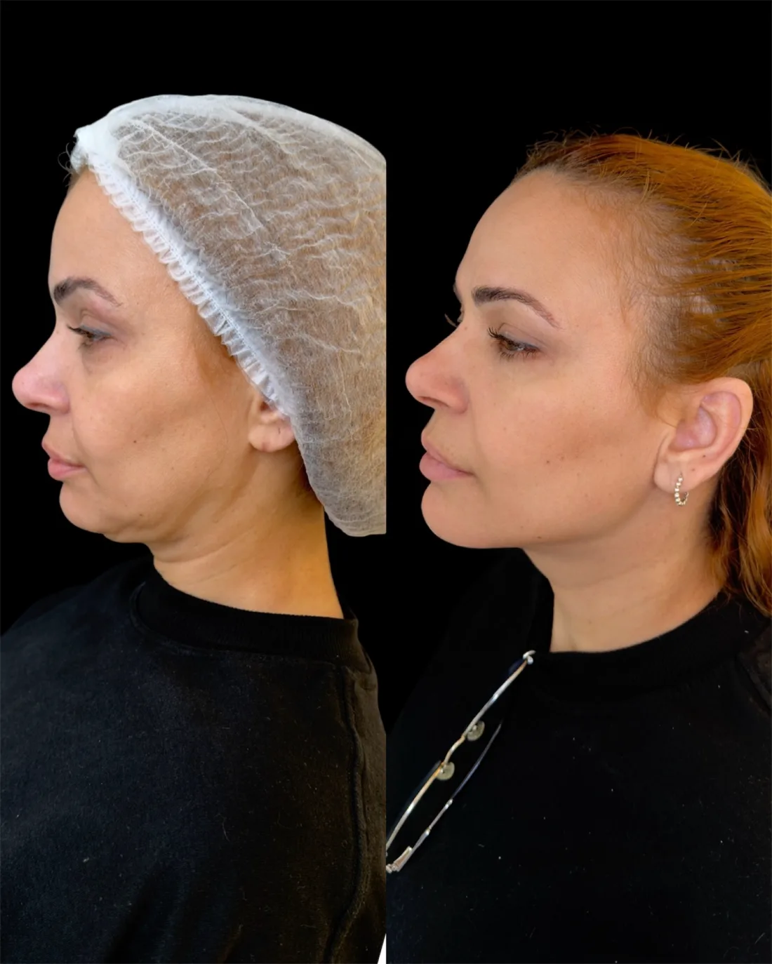 Caso 8 de harmonização facial: registro clínico, antes e depois