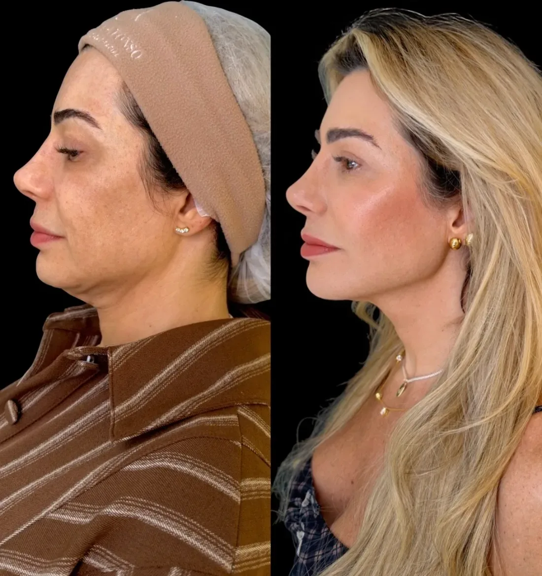 Caso 9 de harmonização facial: registro clínico, antes e depois