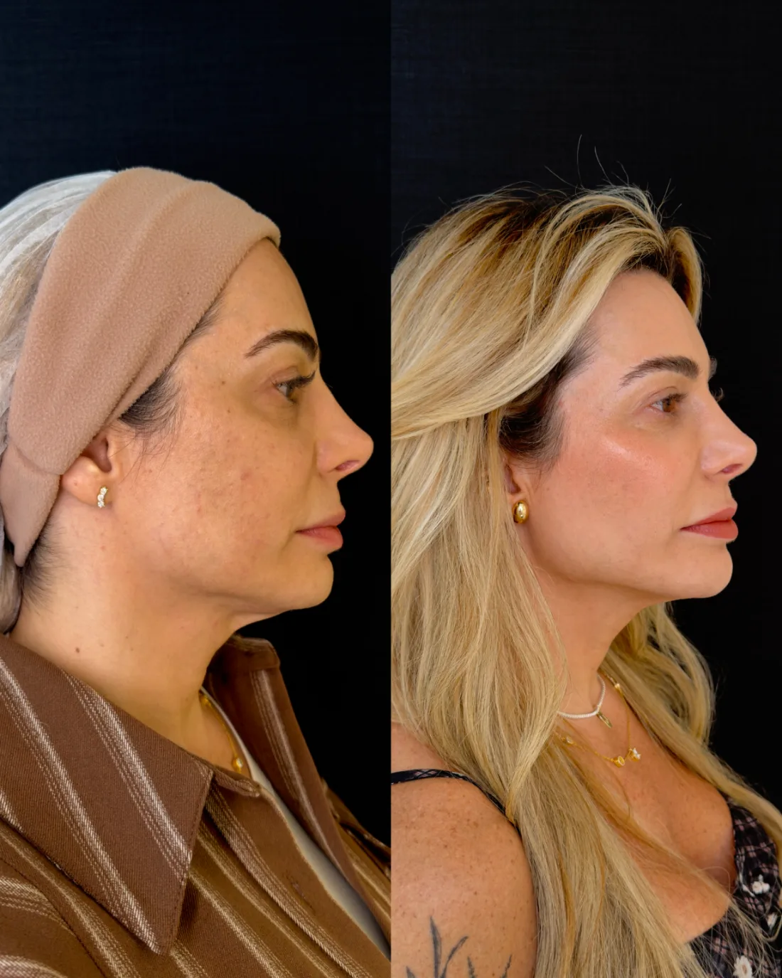 Caso 10 de harmonização facial: registro clínico, antes e depois