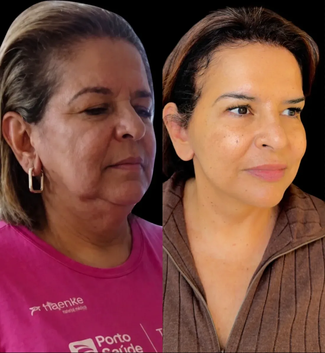 Caso 11 de harmonização facial: registro clínico, antes e depois