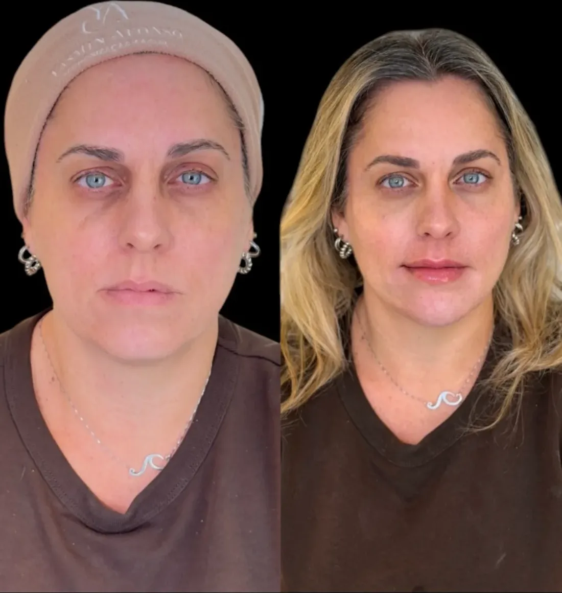Caso 12 de harmonização facial: registro clínico, antes e depois