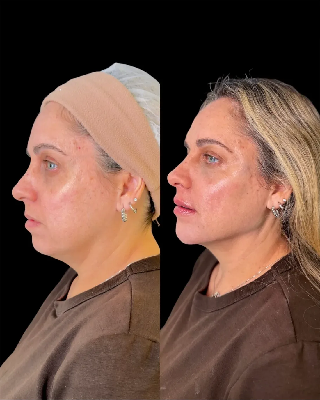 Caso 13 de harmonização facial: registro clínico, antes e depois