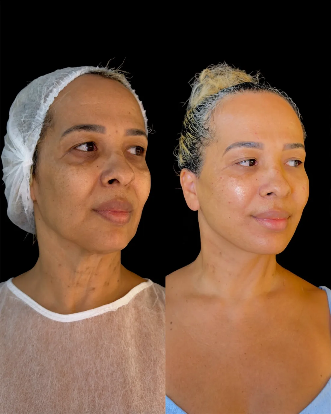Caso 14 de harmonização facial: registro clínico, antes e depois