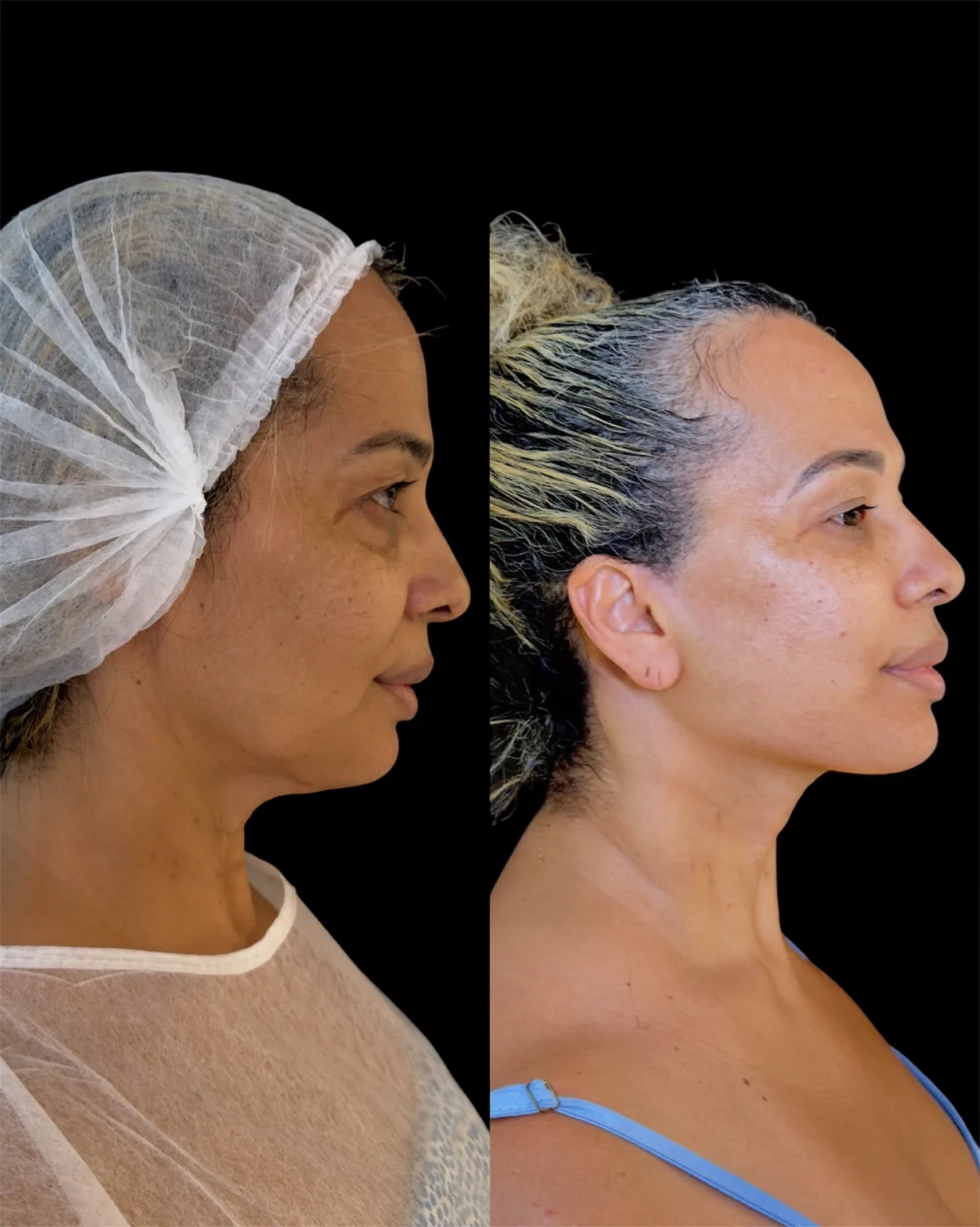 Caso 15 de harmonização facial: registro clínico, antes e depois